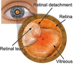 When my retina detached, I barely knew what a retina was.